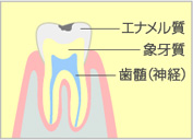 軽度のむし歯