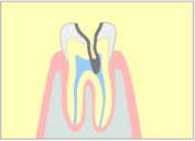 重度のむし歯