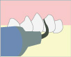 1 歯石の除去