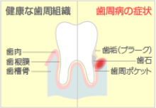 歯周病の原因